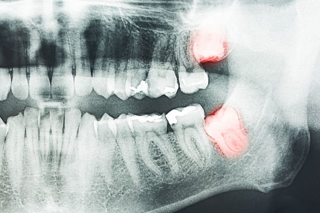 x-ray mouth teeth